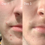 Sulfur Spot Treatment Sulfur Spot Treatment